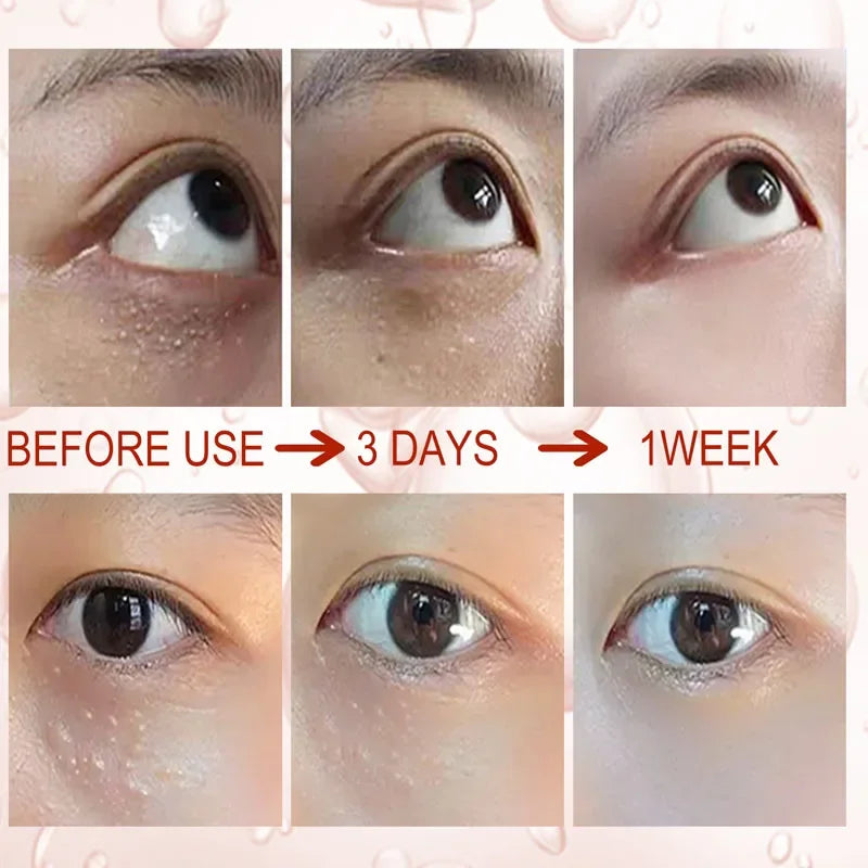 Fat Granules Remover Eye Cream Anti-puffiness Wrinkles Cream Lift Firming Eye Fade Fine Lines Anti-Age Dark Circles Eye Care